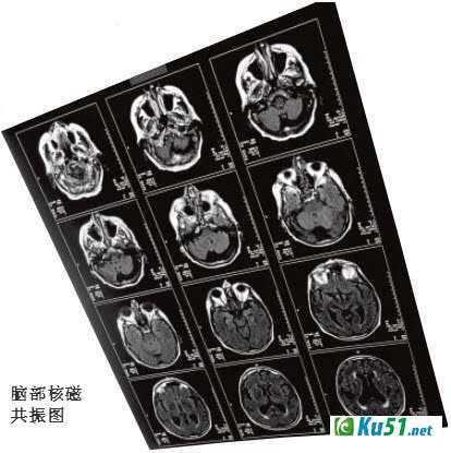 为什么做脑电图不会损伤大脑?