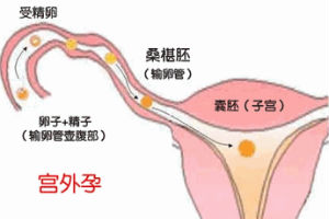 造成宫外孕的原因